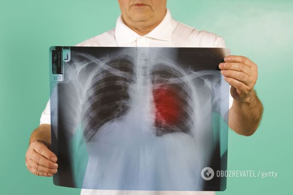 Легені людини, яка хворіє на коронавірус. Джерело: ілюстрація